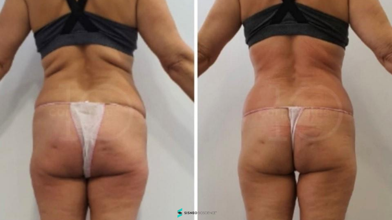 Resultado silueta integral