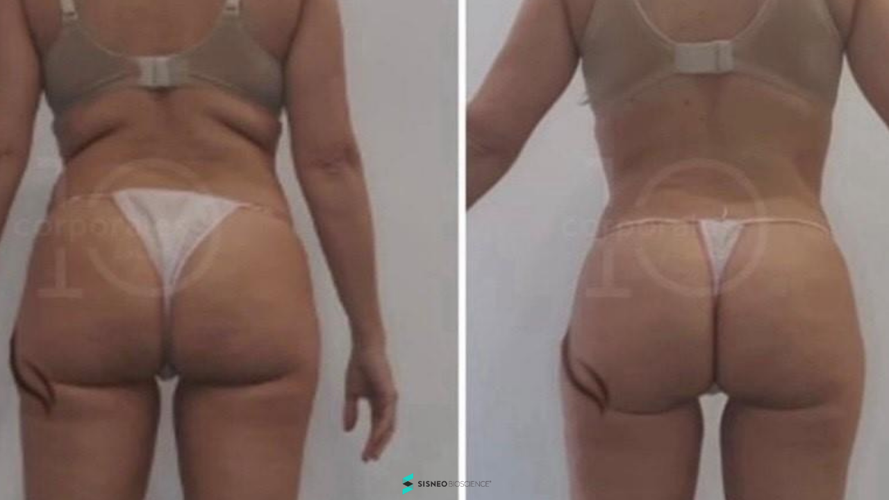 Resultado celulitis Reset Corporal