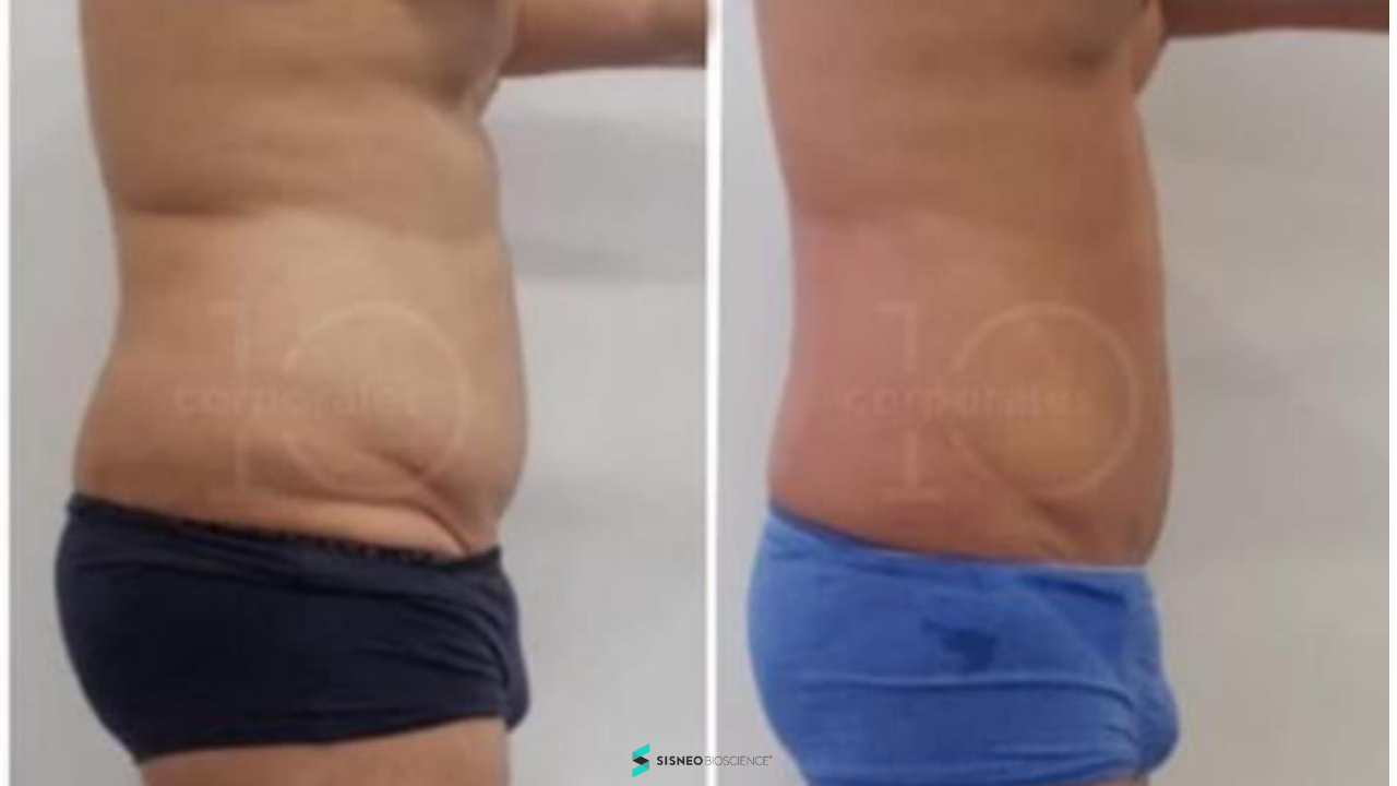 Resultado celulitis lateral