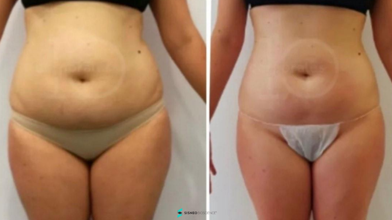 Resultado abdomen Reset Corporal