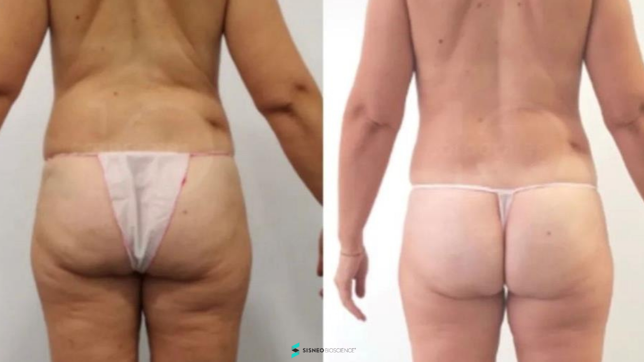 Resultado vientre plano