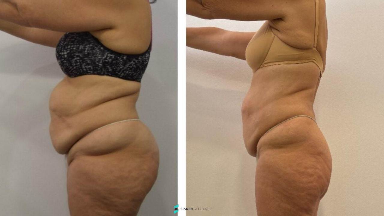 Resultado glúteos