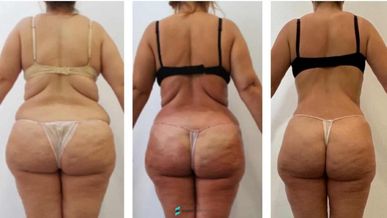 Resultado Reset Corporal