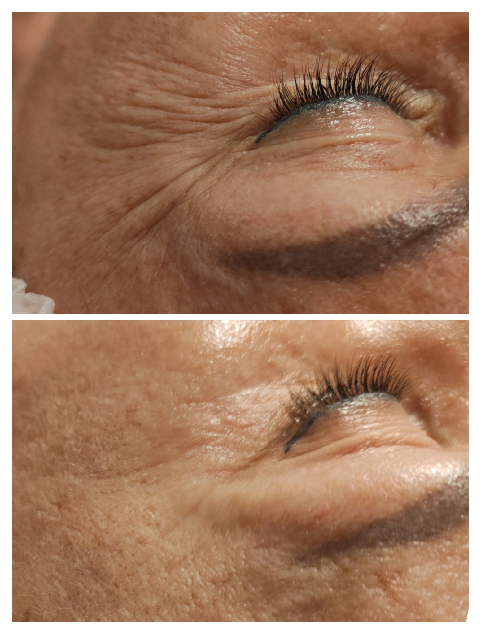 Resultado facial antes y después — cuello y mandíbula