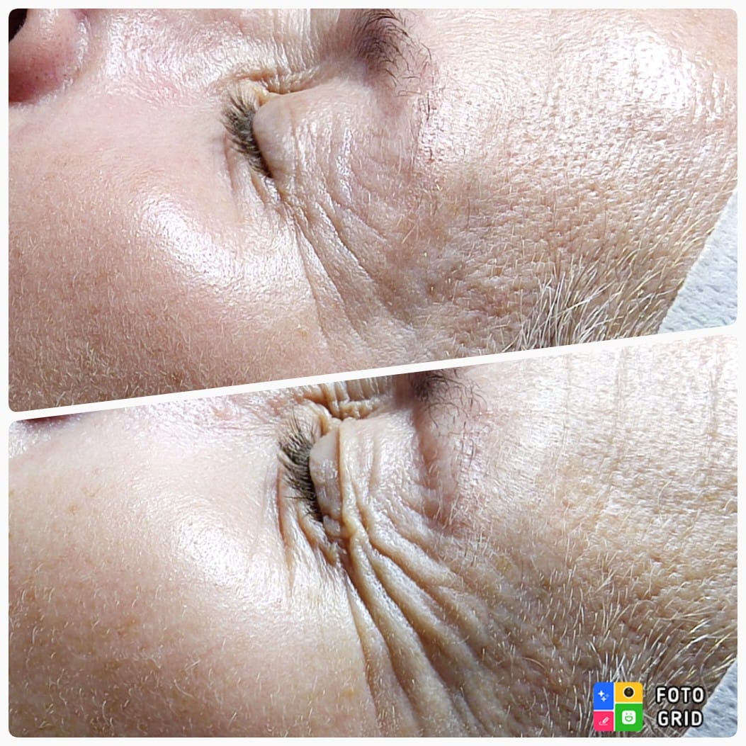 Resultado facial antes y después — frente y arrugas