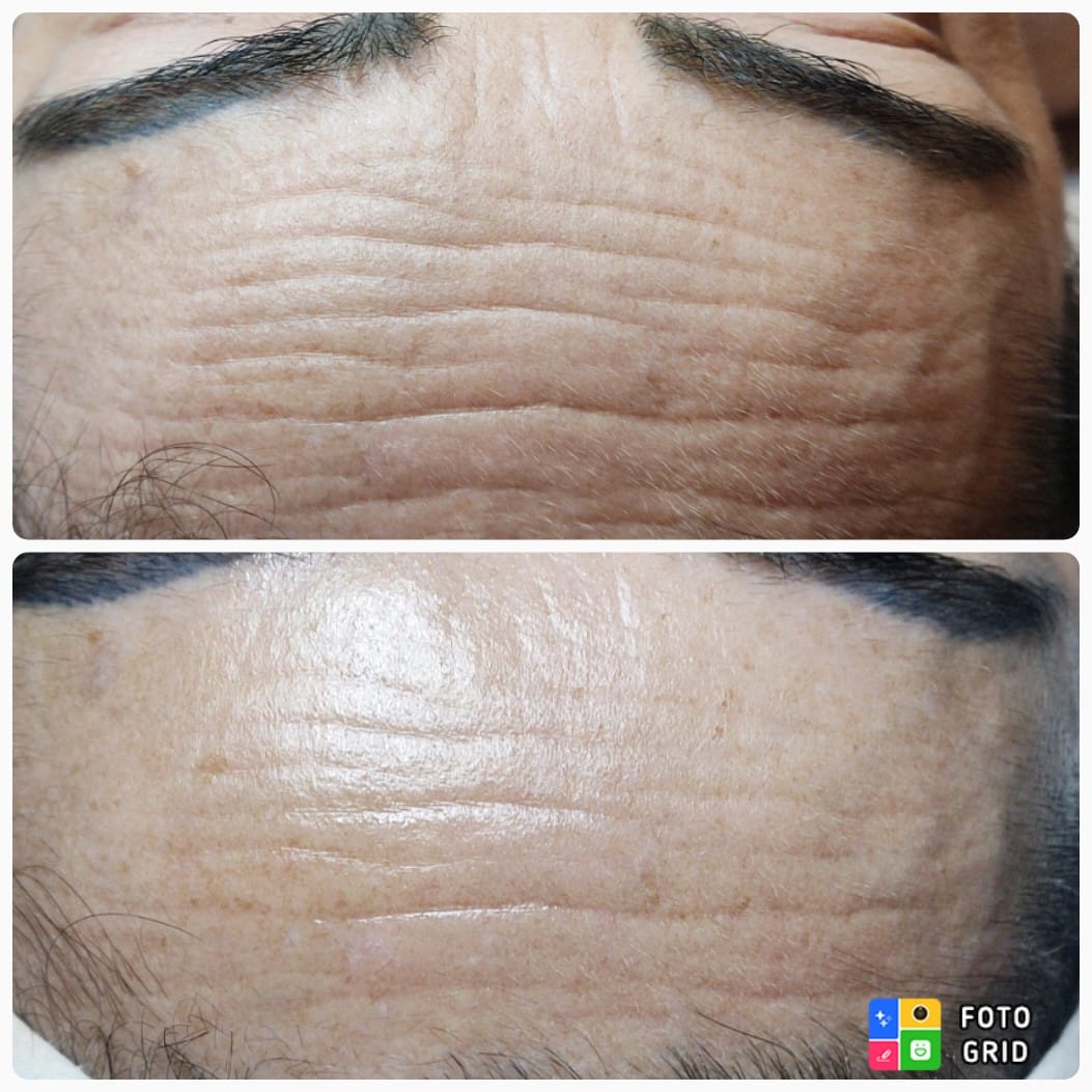 Resultado facial antes y después — rostro completo
