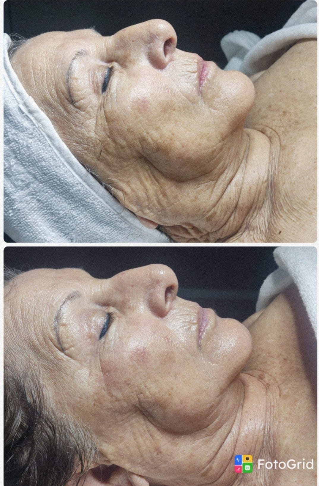 Resultado facial antes y después — zona ocular